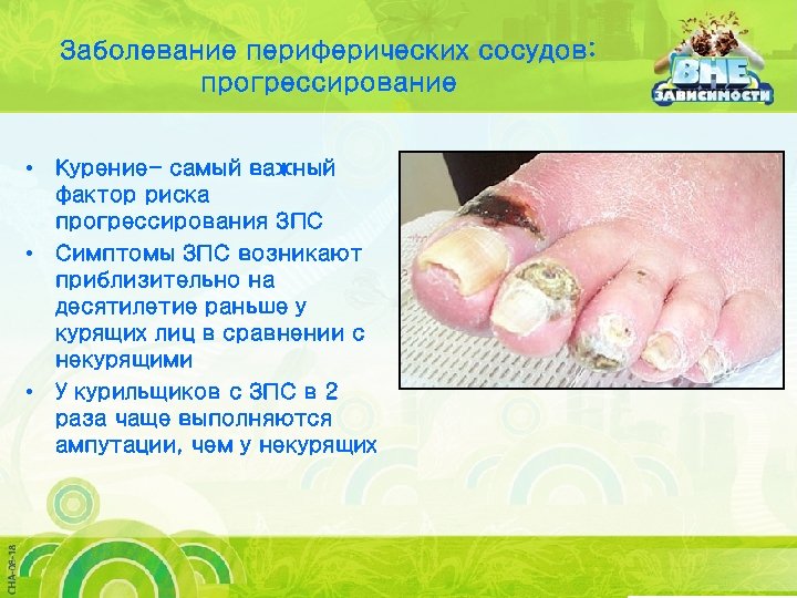 Заболевание периферических сосудов: прогрессирование • Курение- самый важный фактор риска прогрессирования ЗПС • Симптомы