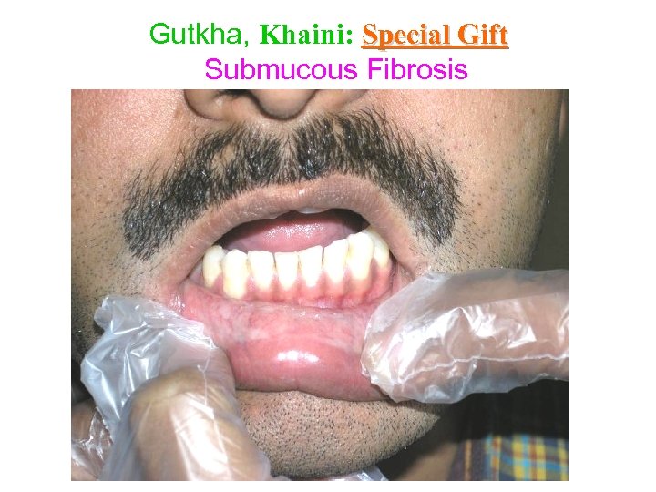 Gutkha, Khaini: Special Gift Submucous Fibrosis 