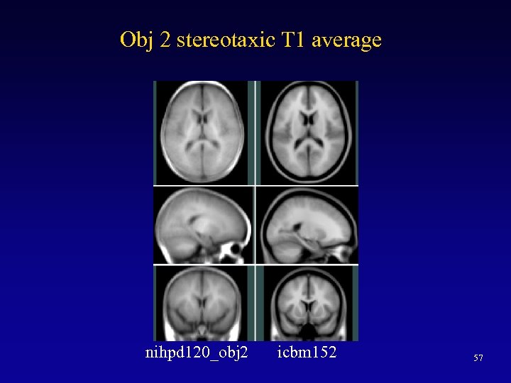 Obj 2 stereotaxic T 1 average nihpd 120_obj 2 icbm 152 57 