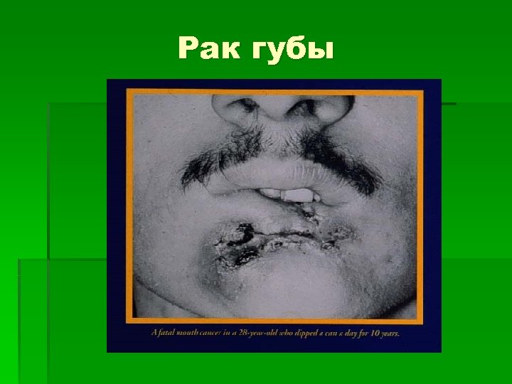 Рак губы 