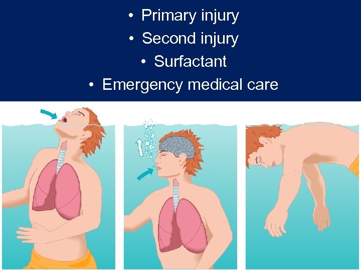  • Primary injury • Second injury • Surfactant • Emergency medical care 
