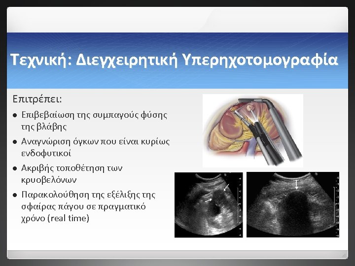 Τεχνική: Διεγχειρητική Υπερηχοτομογραφία Επιτρέπει: l l Επιβεβαίωση της συμπαγούς φύσης της βλάβης Αναγνώριση όγκων