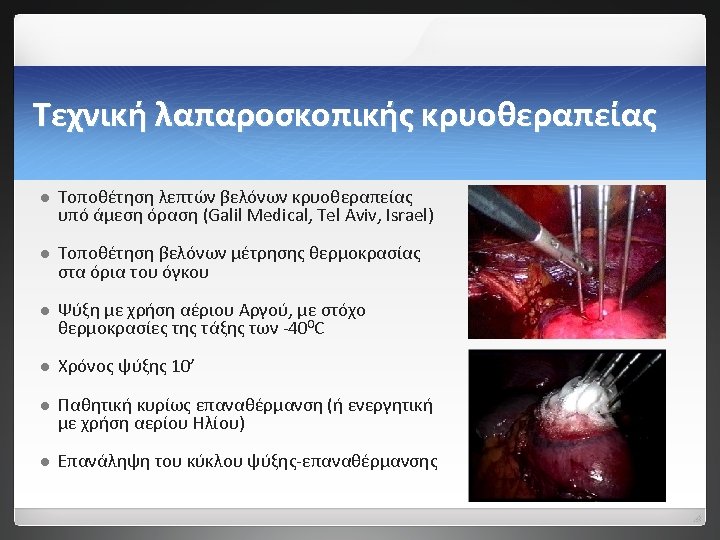 Τεχνική λαπαροσκοπικής κρυοθεραπείας l Τοποθέτηση λεπτών βελόνων κρυοθεραπείας υπό άμεση όραση (Galil Medical, Tel