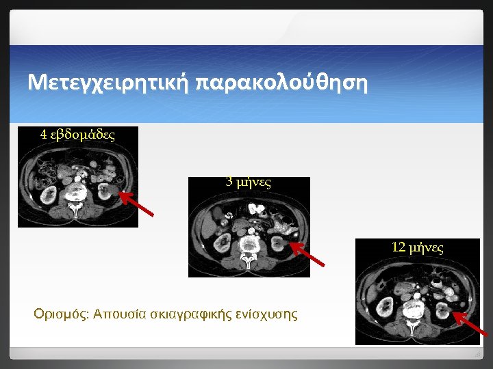 Μετεγχειρητική παρακολούθηση 4 εβδομάδες 3 μήνες 12 μήνες Ορισμός: Απουσία σκιαγραφικής ενίσχυσης 