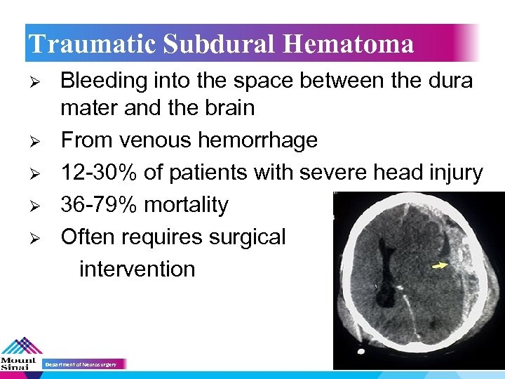 Traumatic Subdural Hematoma Ø Ø Ø Bleeding into the space between the dura mater