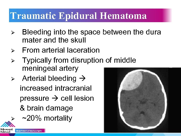 Traumatic Epidural Hematoma Ø Ø Ø Bleeding into the space between the dura mater