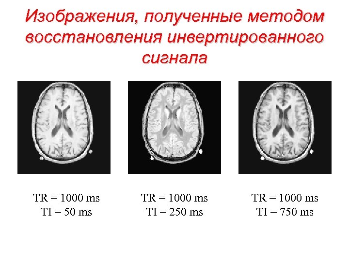Изображения, полученные методом восстановления инвертированного сигнала TR = 1000 ms TI = 50 ms