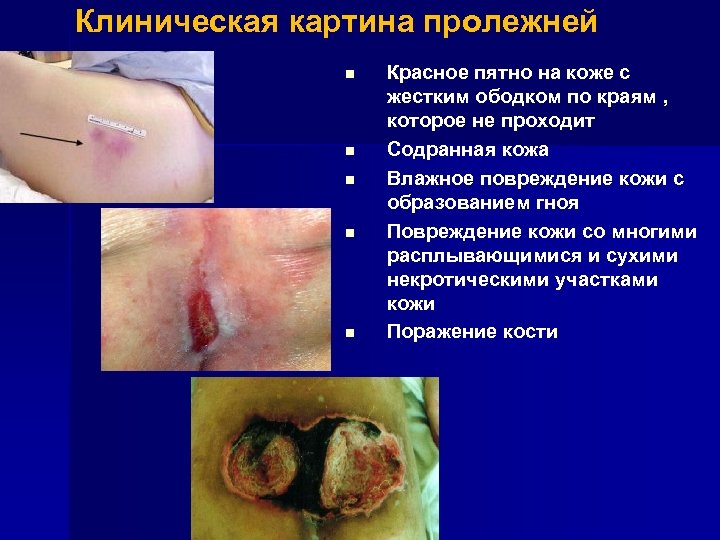 Клиническая картина пролежней n n n Красное пятно на коже с жестким ободком по
