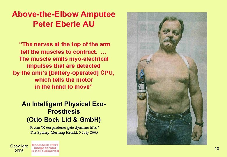 Above-the-Elbow Amputee Peter Eberle AU “The nerves at the top of the arm tell