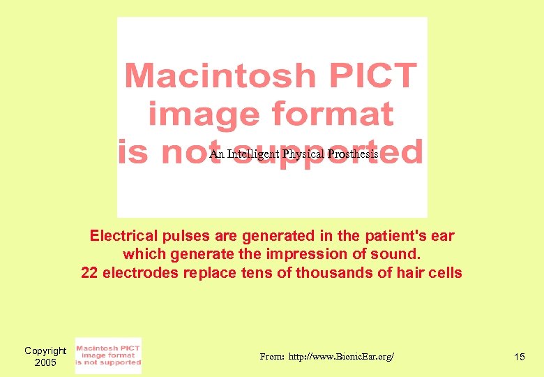 An Intelligent Physical Prosthesis Electrical pulses are generated in the patient's ear which generate