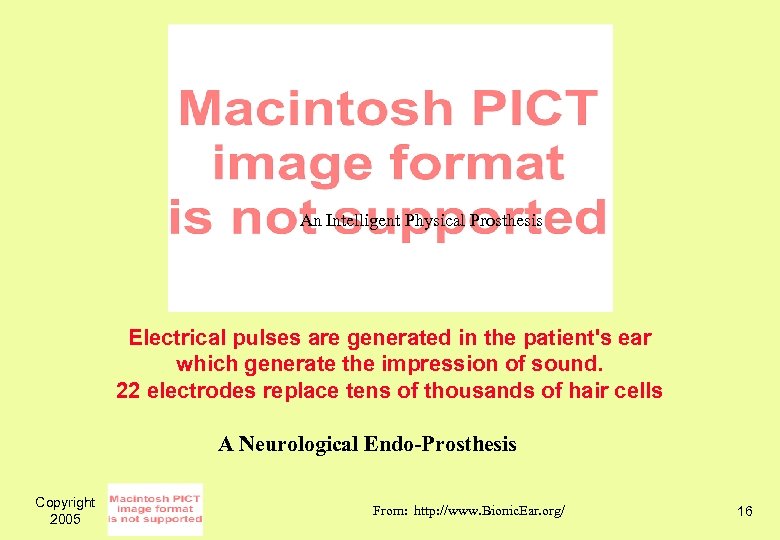 An Intelligent Physical Prosthesis Electrical pulses are generated in the patient's ear which generate