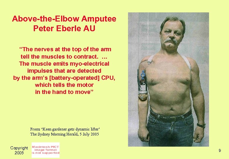 Above-the-Elbow Amputee Peter Eberle AU “The nerves at the top of the arm tell