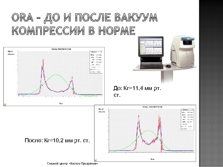 До: Кг=11, 4 мм рт. ст. После: Кг=10, 2 мм рт. ст. Глазной центр