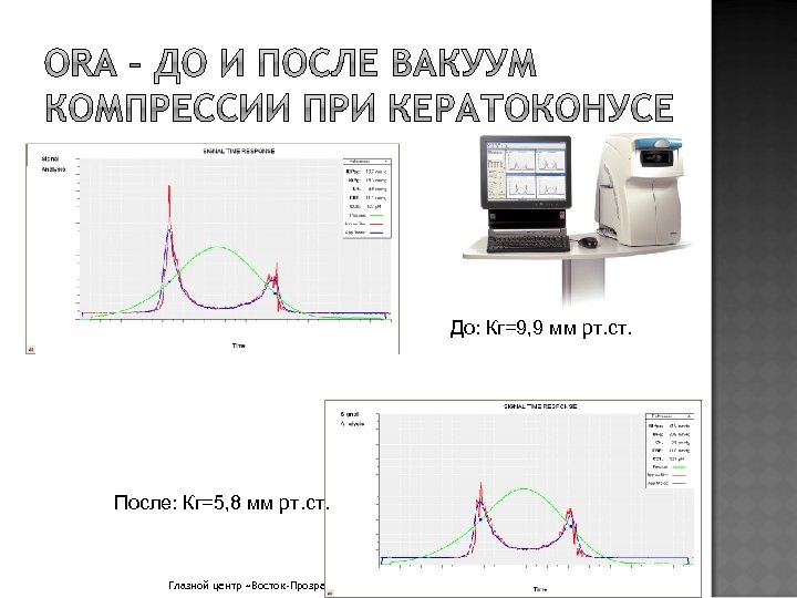 До: Кг=9, 9 мм рт. ст. После: Кг=5, 8 мм рт. ст. Глазной центр
