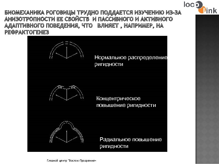 Нормальное распределение ригидности Концентрическое повышение ригидности Радиальное повышение ригидности Глазной центр "Восток-Прозрение» 