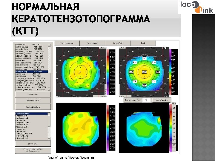 НОРМАЛЬНАЯ КЕРАТОТЕНЗОТОПОГРАММА (КТТ) Глазной центр "Восток-Прозрение 