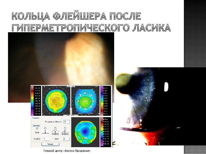 Картинки кератоконуса при оптической когерентной томографии