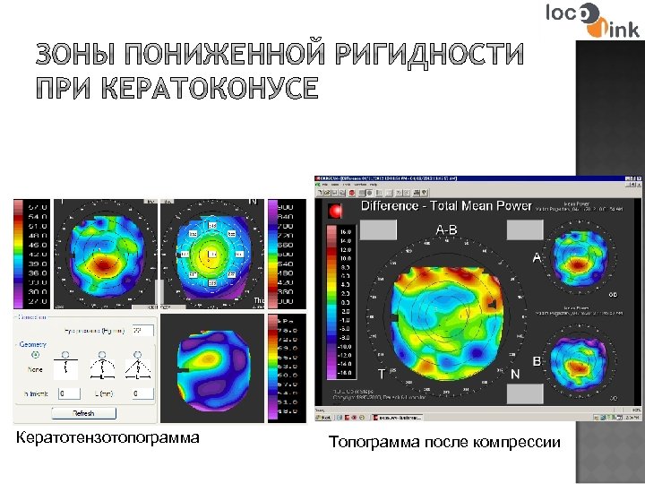 Кератотензотопограмма Топограмма после компрессии 