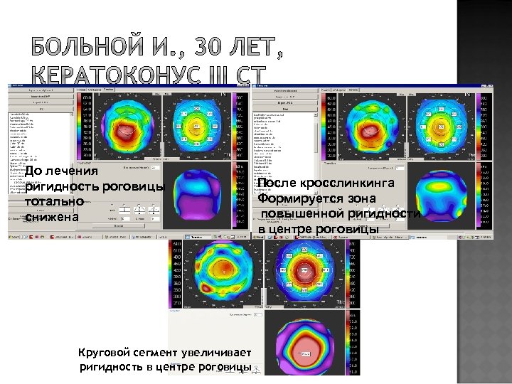 Презентация на тему кератоконус