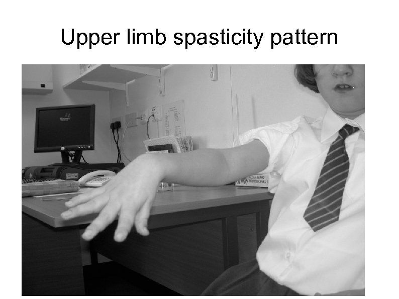 Upper limb spasticity pattern 