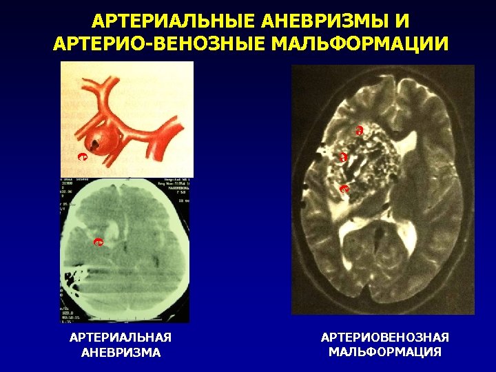 АРТЕРИАЛЬНЫЕ АНЕВРИЗМЫ И АРТЕРИО-ВЕНОЗНЫЕ МАЛЬФОРМАЦИИ е е е АРТЕРИАЛЬНАЯ АНЕВРИЗМА АРТЕРИОВЕНОЗНАЯ МАЛЬФОРМАЦИЯ 