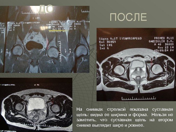 ДО ПОСЛЕ На снимках стрелкой показана суставная щель: видна ее ширина и форма. Нельзя