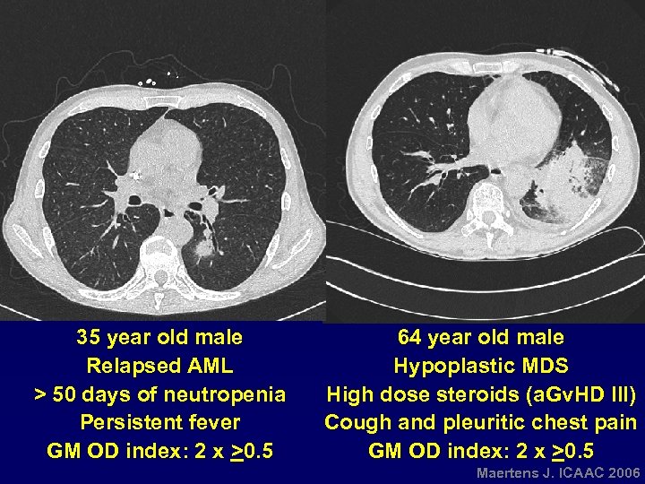 35 year old male Relapsed AML > 50 days of neutropenia Persistent fever GM
