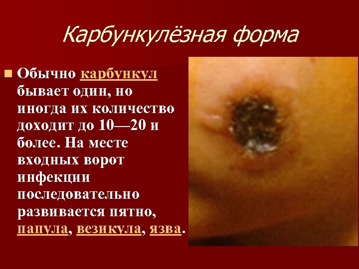Карбункулёзная форма n Обычно карбункул бывает один, но иногда их количество доходит до 10—