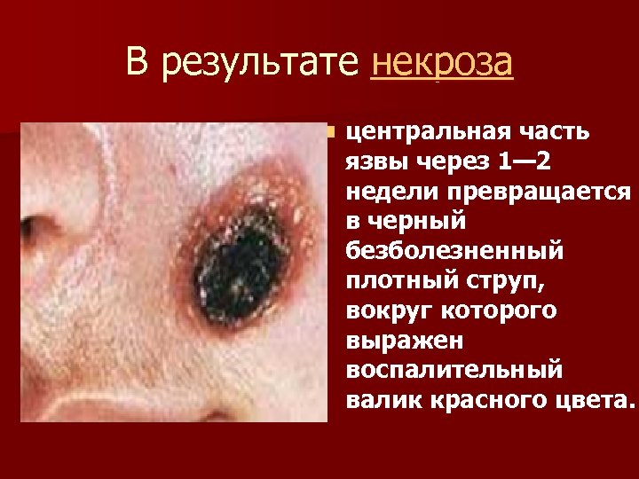 В результате некроза n центральная часть язвы через 1— 2 недели превращается в черный