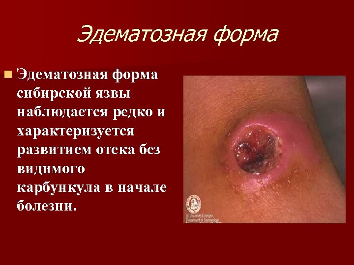 Эдематозная форма n Эдематозная форма сибирской язвы наблюдается редко и характеризуется развитием отека без