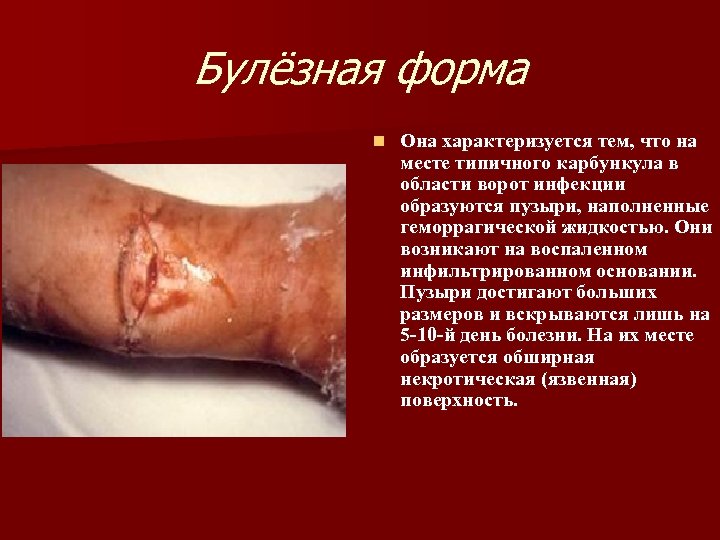 Булёзная форма n Она характеризуется тем, что на месте типичного карбункула в области ворот
