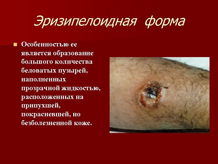 Эризипелоидная форма n Особенностью ее является образование большого количества беловатых пузырей, наполненных прозрачной жидкостью,