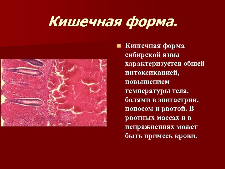 Кишечная форма. n Кишечная форма сибирской язвы характеризуется общей интоксикацией, повышением температуры тела, болями