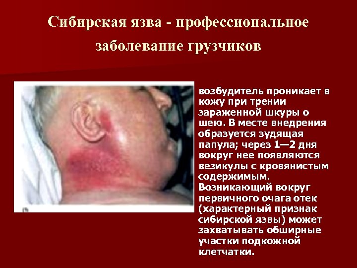Сибирская язва - профессиональное заболевание грузчиков n возбудитель проникает в кожу при трении зараженной