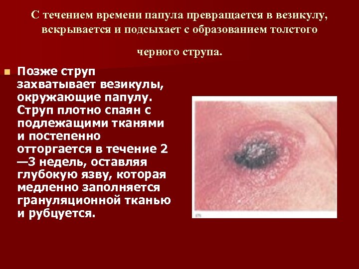 С течением времени папула превращается в везикулу, вскрывается и подсыхает с образованием толстого черного