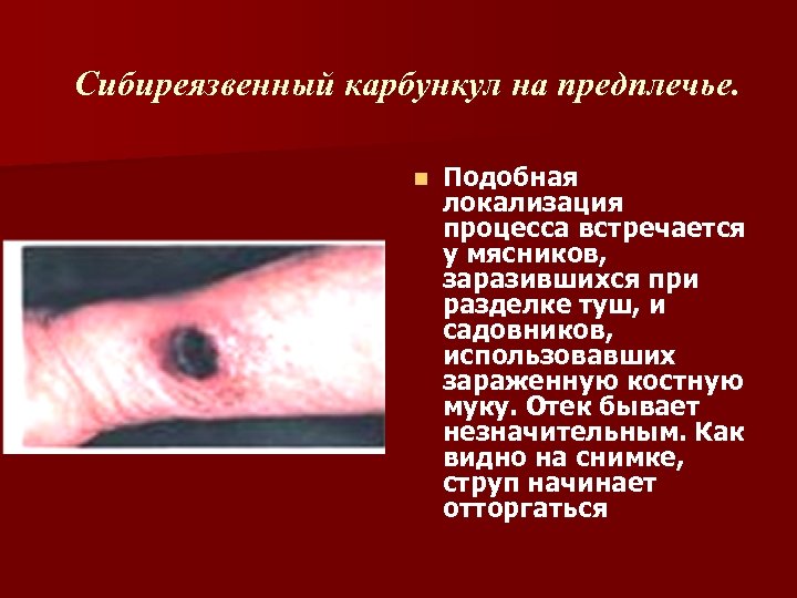 Сибиреязвенный карбункул на предплечье. n Подобная локализация процесса встречается у мясников, заразившихся при разделке