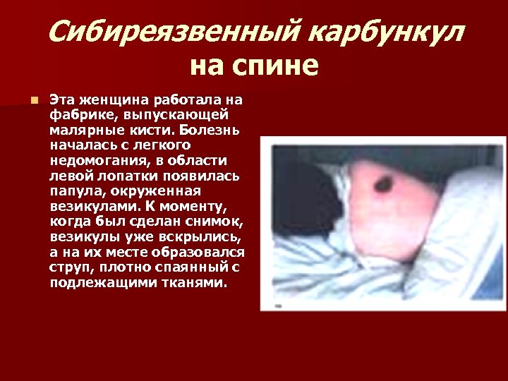 Сибиреязвенный карбункул на спине n Эта женщина работала на фабрике, выпускающей малярные кисти. Болезнь