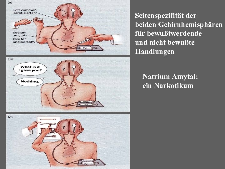 Seitenspezifität der beiden Gehirnhemisphären für bewußtwerdende und nicht bewußte Handlungen Natrium Amytal: ein Narkotikum