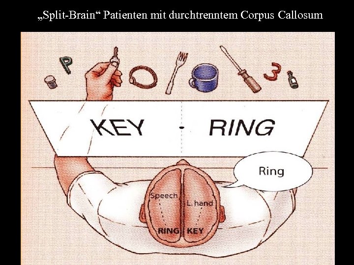 „Split-Brain“ Patienten mit durchtrenntem Corpus Callosum 