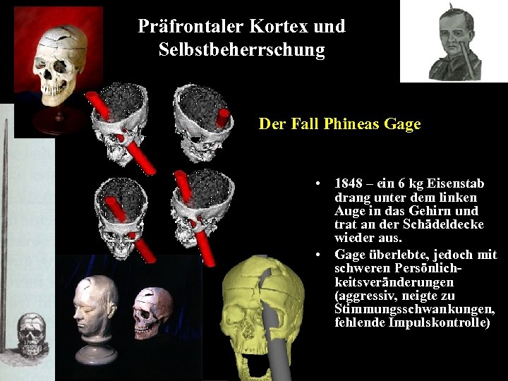 Präfrontaler Kortex und Selbstbeherrschung Der Fall Phineas Gage • 1848 – ein 6 kg