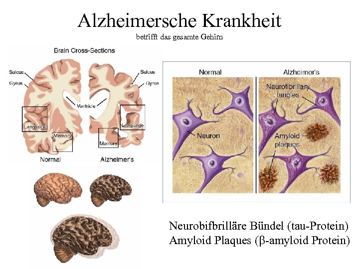 Alzheimersche Krankheit betrifft das gesamte Gehirn Neurobifbrilläre Bündel (tau-Protein) Amyloid Plaques (b-amyloid Protein) 