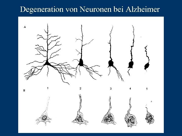 Degeneration von Neuronen bei Alzheimer 