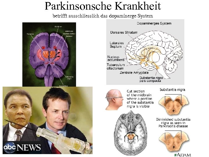 Parkinsonsche Krankheit betrifft ausschliesslich das dopaminerge System 