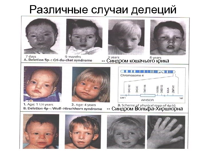 Различные случаи делеций -- Синдром кошачьего крика -- Синдром Вольфа-Хиршхорна 