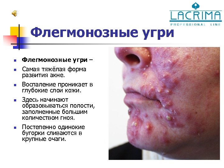 Флегмонозные угри n n n Флегмонозные угри – Самая тяжёлая форма развития акне. Воспаление