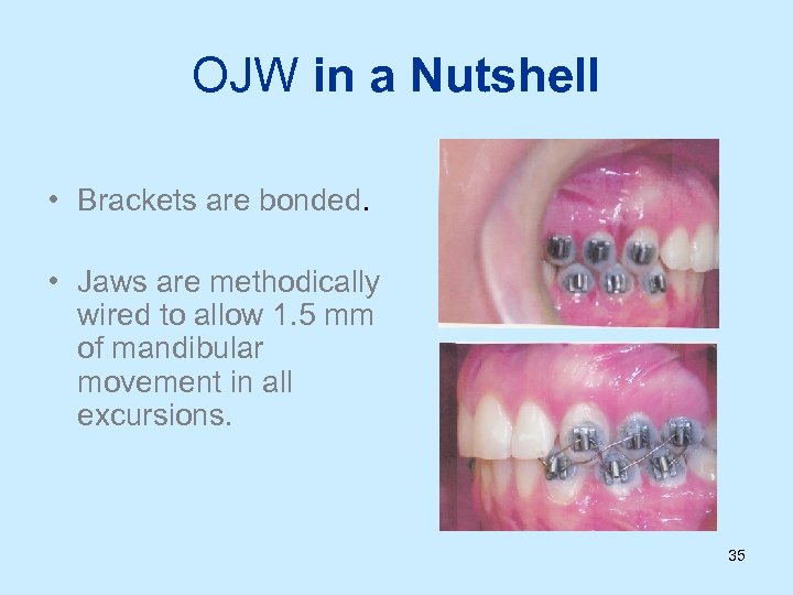 OJW in a Nutshell • Brackets are bonded. • Jaws are methodically wired to