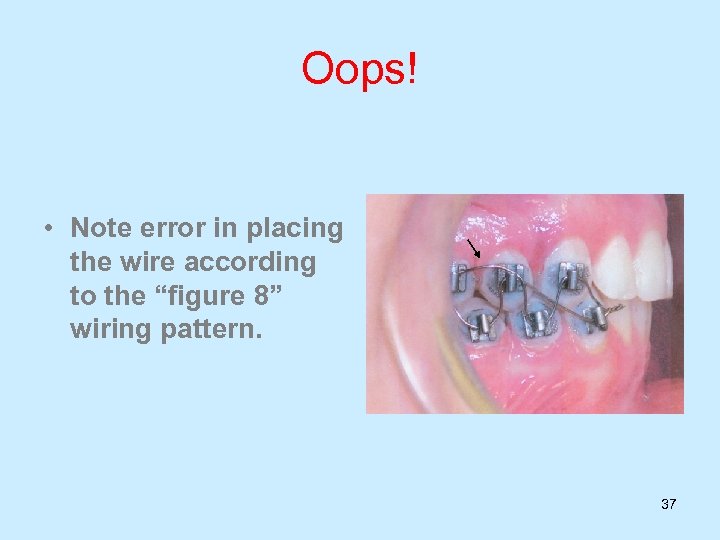 Oops! • Note error in placing the wire according to the “figure 8” wiring