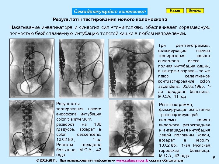 Самодвижущийся колоноскоп Результаты тестирования нового колоноскопа Накатывание инвагинатора и синергия сил «тяни-толкай» обеспечивает соразмерную,
