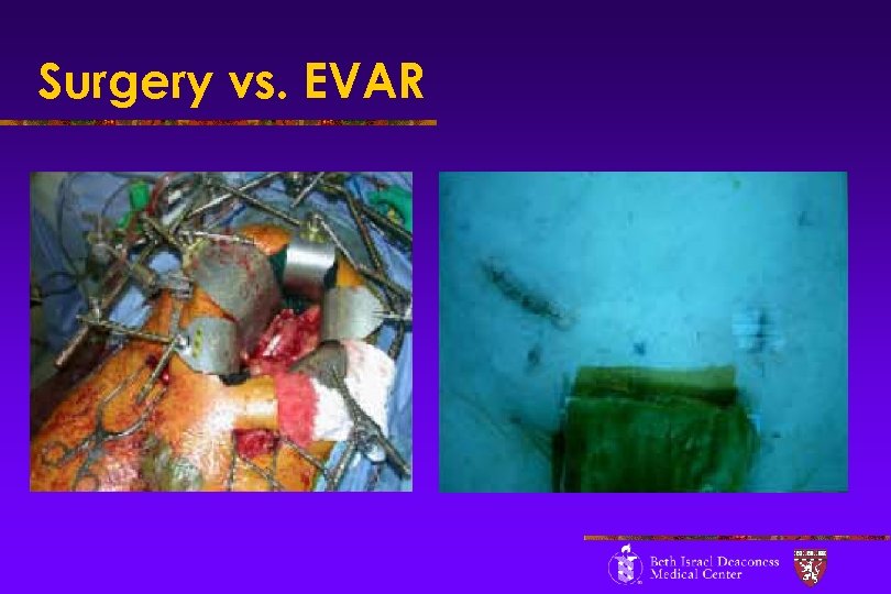 Surgery vs. EVAR 