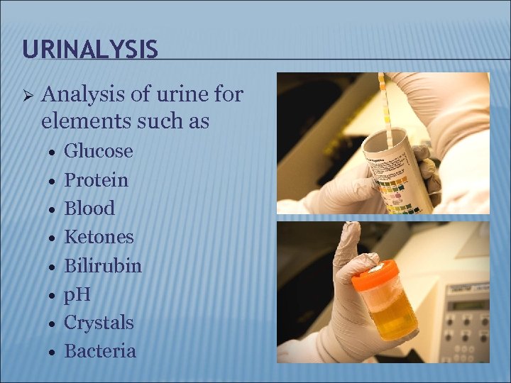 URINALYSIS Ø Analysis of urine for elements such as Glucose Protein Blood Ketones Bilirubin